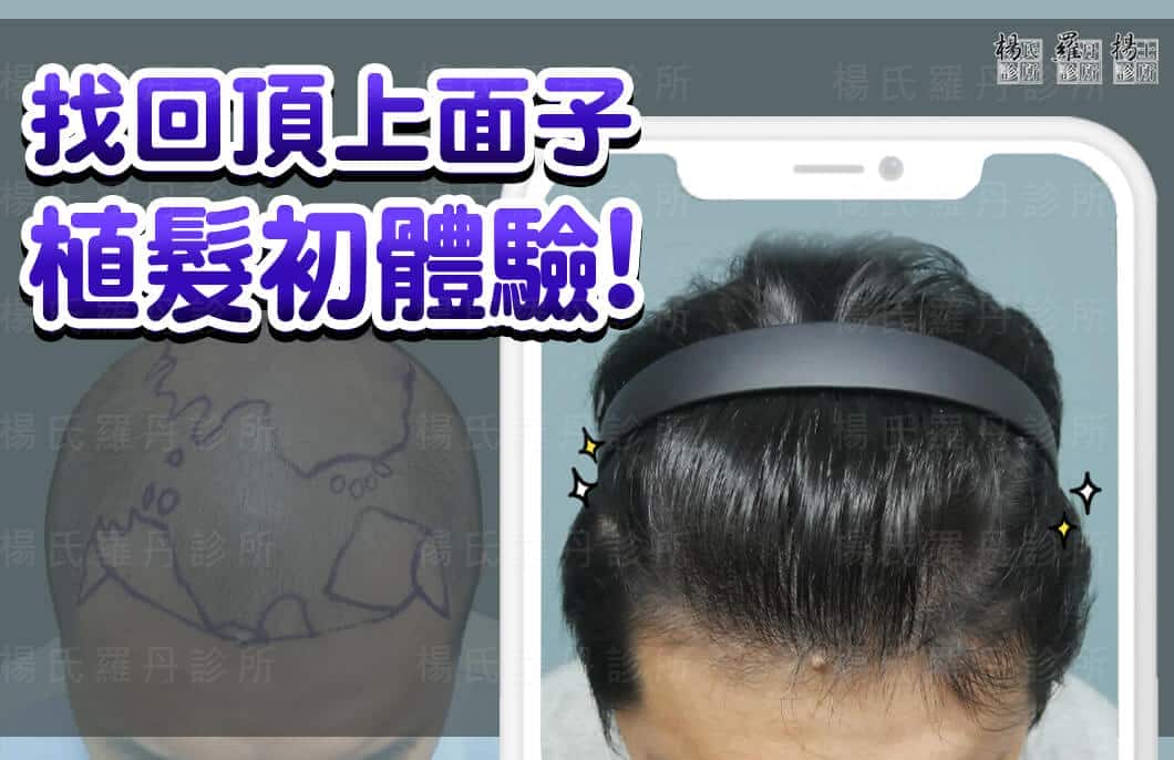 【植髮】幫你找回頂上面子，ARTAS植髮初體驗!!